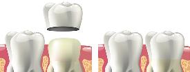 Crowns with our Emergency Dentist in Kettering and Wellingborough