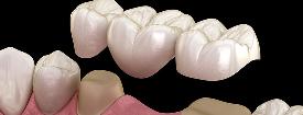 Bridges with our Emergency Dentist in Kettering and Wellingborough