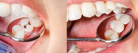 Fillings with our Emergency Dentist in Kettering and Wellingborough
