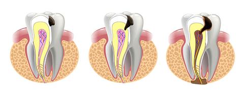 Root canal with our Emergency Dentist in Kettering and Wellingborough